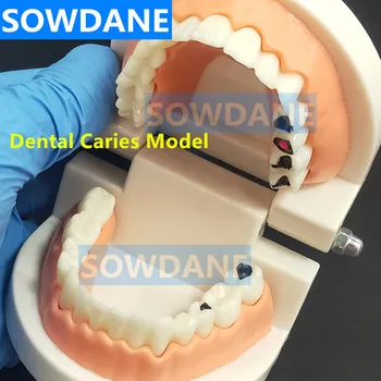 Модель зуба, модель зубов, модель кариеса, модель для общения с пациентом, модель для исследования стоматолога с разрушенным зубом 5